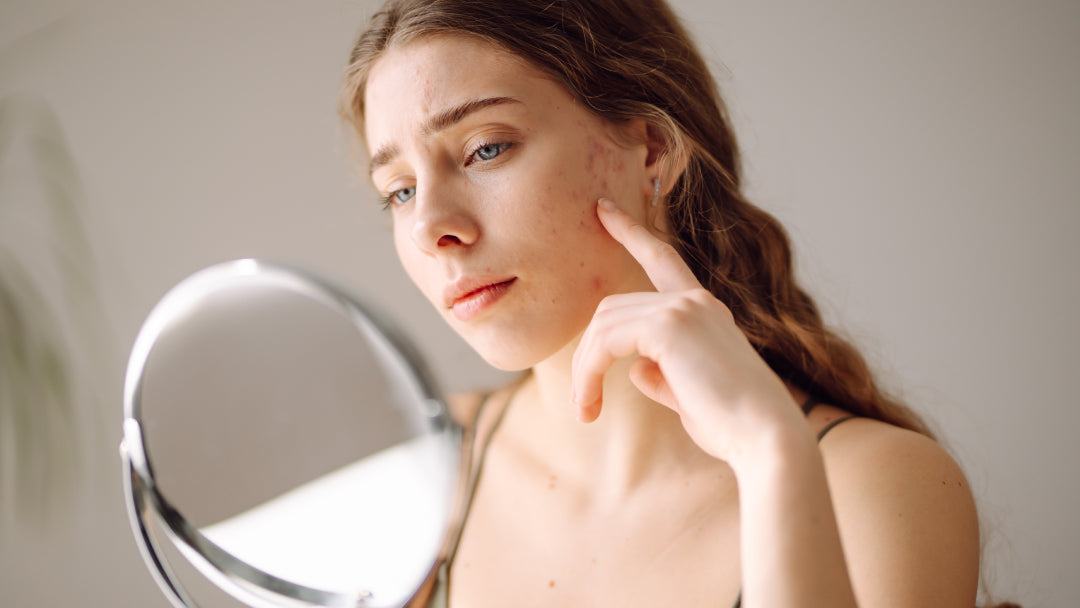 A woman gazes into a mirror, examining her face with a focus on a noticeable subcutaneous pimple.